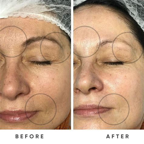 ZEMITS DermeLuxx | Esthetic Spa Equipment for sale