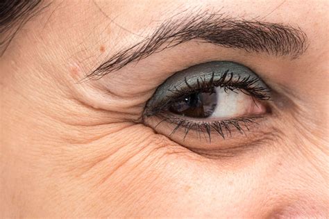 Crow’s Feet - Fine lines and wrinkles around the eye - Dr Reena