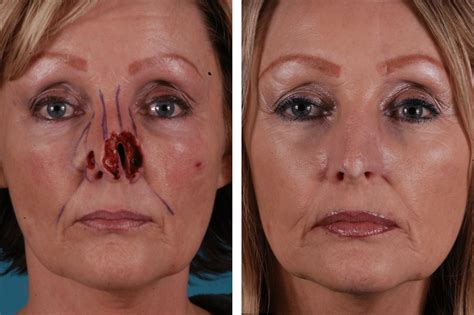 16. Forehead Flap - Case 4 - Mobley MD