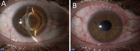 Ectopia Lentis with Microspherophakia in Marfan Syndrome Resolved with ...