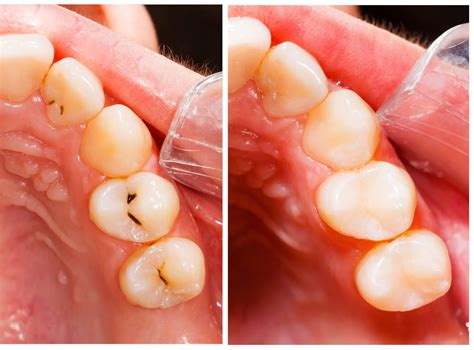 White Cavity Filling - Replace Amalgam Fillings Dentist in Lake Elsinore