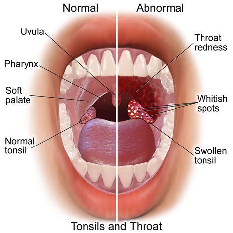 Tonsillitis and Adenoiditis - Causes, Diagnosis and Treatment