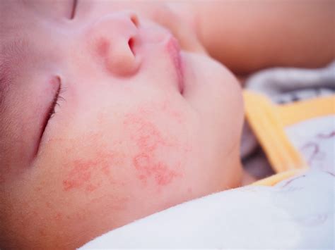 Baby Heat Rash Vs Eczema
