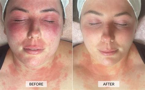 What is Rosacea and how can LED light therapy help? | CurrentBody Australia