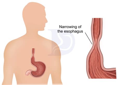 Esophageal Stricture Dilation