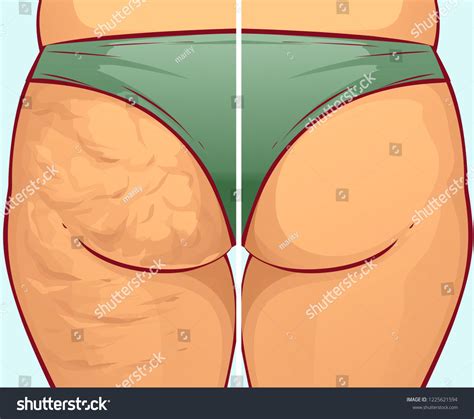 Cellulite On Buttocks Beforeafter Vector Illustration Stock Vector (Royalty Free) 1225621594 ...
