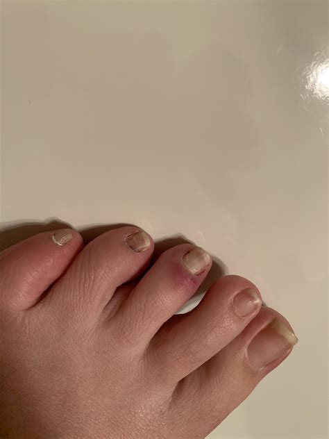 I stubbed my middle toe a few days ago and the toenail detached from the base. It was still ...