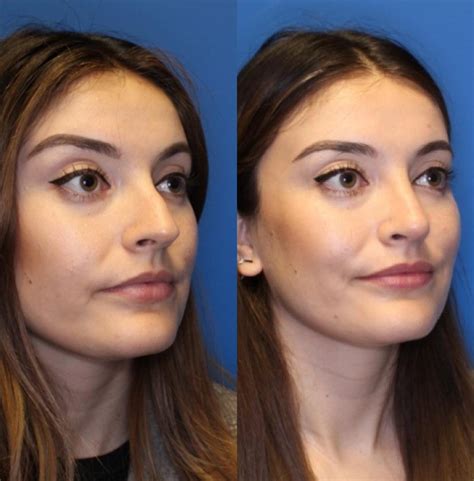 Rhinoplasty Surgery