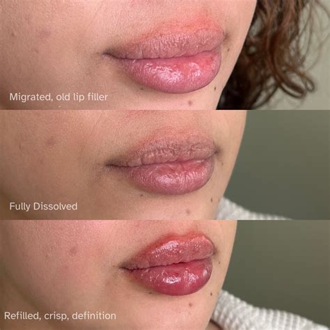 Dissolving Filler - Filler Nodules and Complication Management