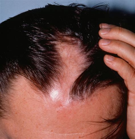 Coup De Sabre Scleroderma , Sklerodermie: Symptome, Verlauf, Therapie ...