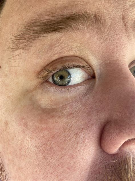 Can eye strain cause swollen lower eyelid?? Please help. : r/DermatologyQuestions