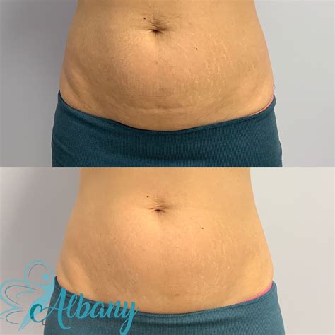 Skin repair | Stretch mark cover up, Stretch mark microneedling, Before ...