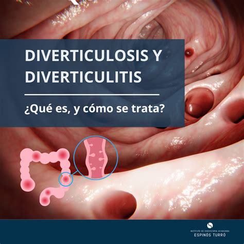 Qué es la diverticulosis y diverticulitis, y cómo se trata - Instituto de Aparato Digestivo Teknon