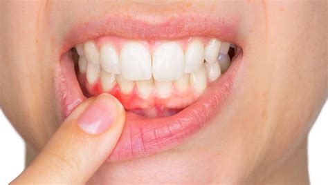 Gum Graft Surgery Recovery Tips | Dental Clinic Toronto, ON