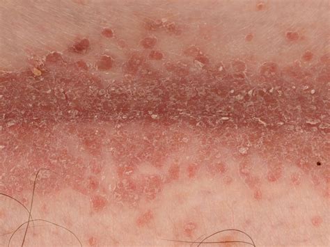 Intertrigo / Intertrigo - Intertrigo - Pictures, Rash, Symptoms, Causes ...