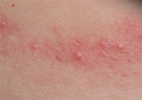 Contact Dermatitis: Causes and Risk Factors