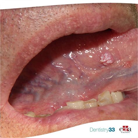 Papillary white excrescence on the tongue - a clinical case | Dentistry33