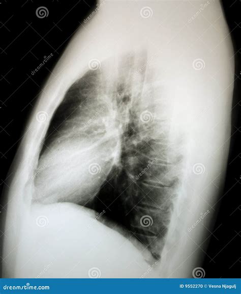 Normal X-ray Of The Chest, Lateral Stock Photo - Image: 9552270