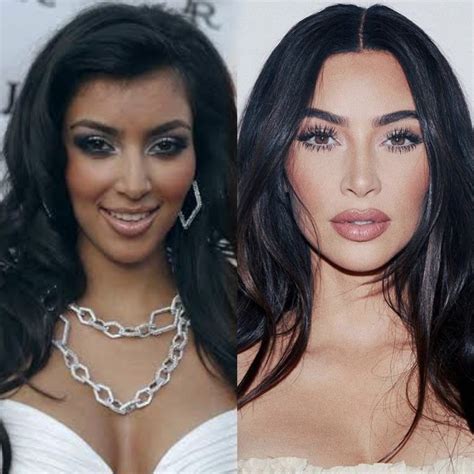 Kim Kardashian Plastic Surgery Before And After