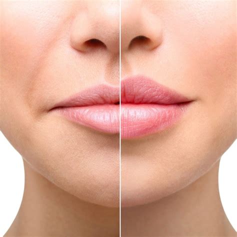 Lip Filler Swelling Stages: Navigate the Healing Journey for Perfect Lips!