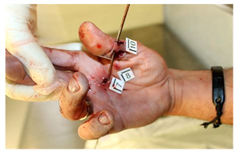 Gunshot Defense Wounds: Three Case Reports and a Literature Review