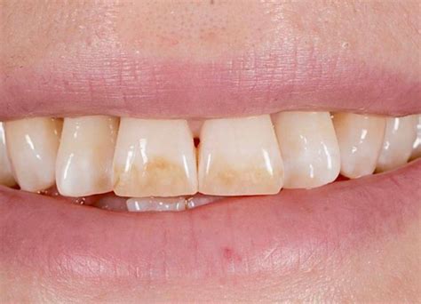 Gum Abscess Popped? Thinking of Popping It Yourself?