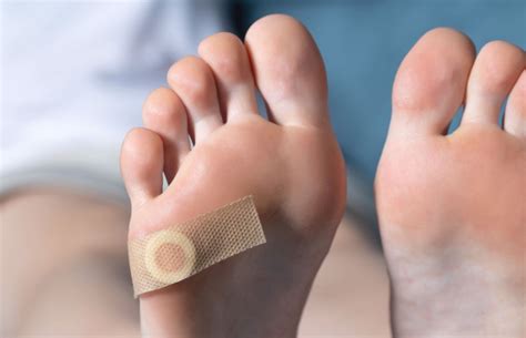 Foot Seed Corn Removal: Tips and Techniques for Getting Rid of Corns