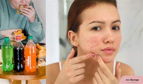 5 Foods That Cause Acne and Breakouts - Eve Therapy