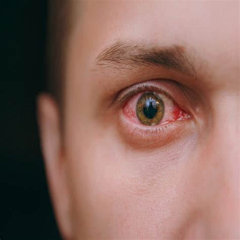 Flashing Lights In Eyes Treatment at Jade Stainforth blog