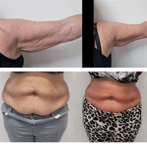 Liquid Lipo Fat Dissolving Gel - Cheshire Skin & Laser Clinic