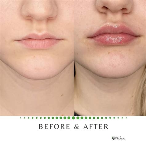 Lip Injections Before And After 1Ml at Alonzo Christensen blog
