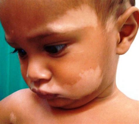 Ash-leaf spots or naevus depigmentosus: a diagnostic challenge | BMJ ...