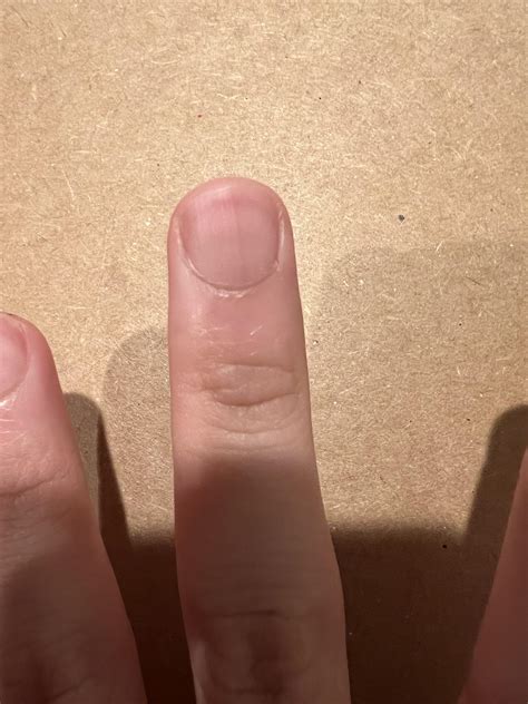 A faint dark line on my finger nail : r/Melanoma