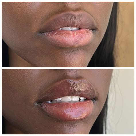 Fullips Before And After