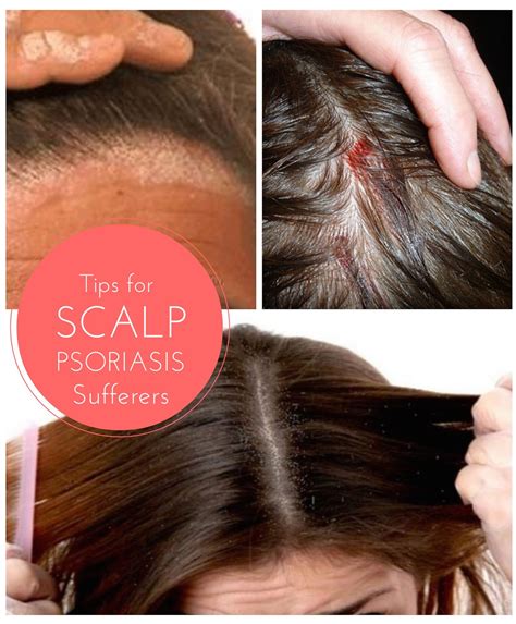 Scalp Plaque Hair Loss at Amparo Lisi blog