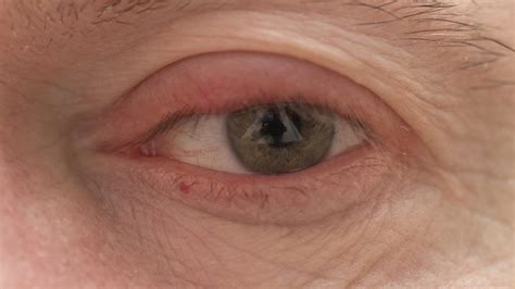 Why My Eyelid is Swollen? - PEL