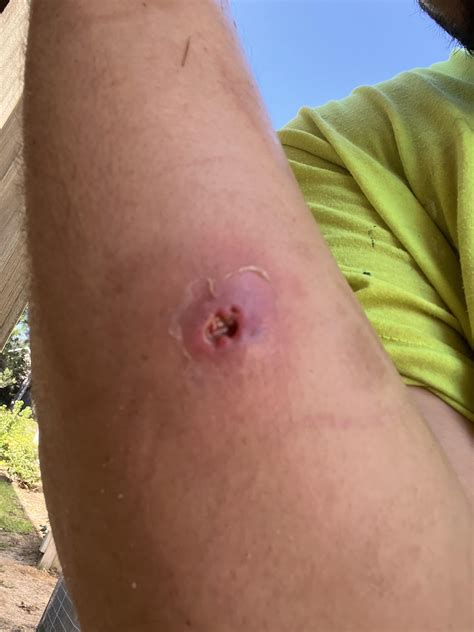 What Do Brown Recluse Spider Bites Look Like At First Spider Bites