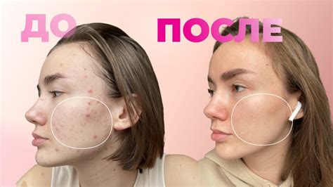 Как сказывается на коже отказ от сладкого и сахарного песка. Такого ...
