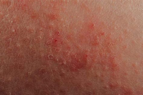 20 Types of Skin Lesions: Causes and Pictures