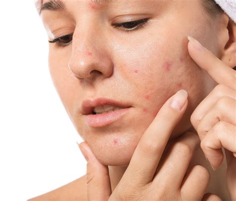 Can Stress Cause Acne or Make It Worse?