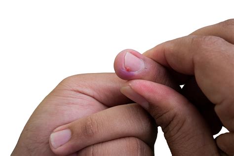 selective focus on bruised middle fingernails due to ingrown nails. in Indonesian it is called ...