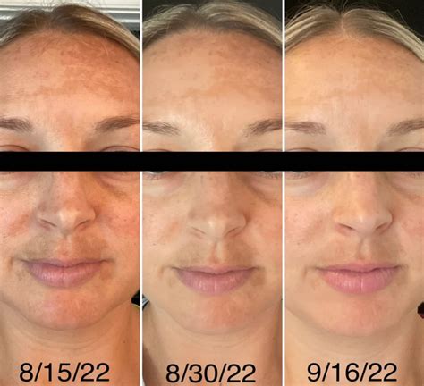 Beef Tallow for Skin Before and After Results