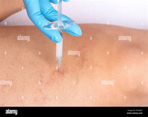 Removal of varicose veins on the legs. Medical inspection and treatment of Telangiectasia ...