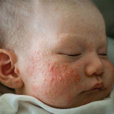 Baby Acne - causes and treatment - Daisy First Aid