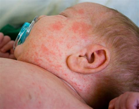 Sarpullido En Bebes