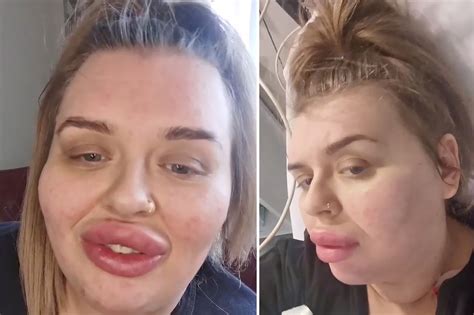 Lip Filler Gone Bad at Harry Boykin blog
