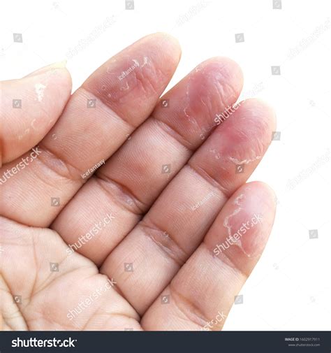 Eczema Fingertips