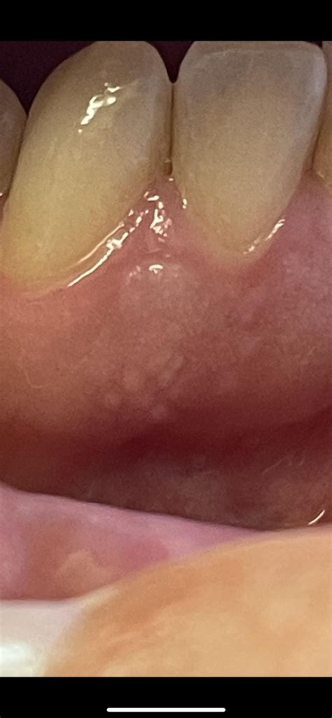 White patch and bumps on gums : r/PeriodontalDisease