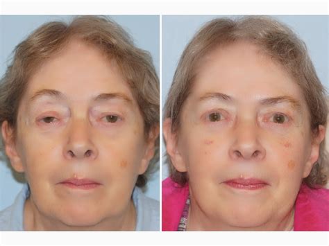 Facial Plastic Surgery: Lazy eye, Ptosis repair, Upper blepharoplasty, Levator advancement ...