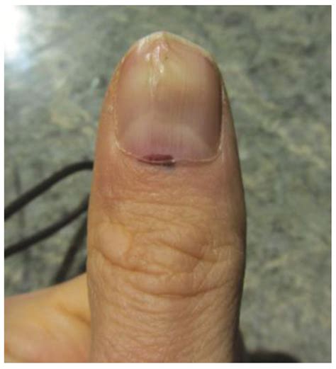 Melanoma Nail